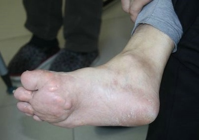 手关节痛和脚后跟痛脚趾痛吃什么药6_大脚趾痛_脚趾尖痛